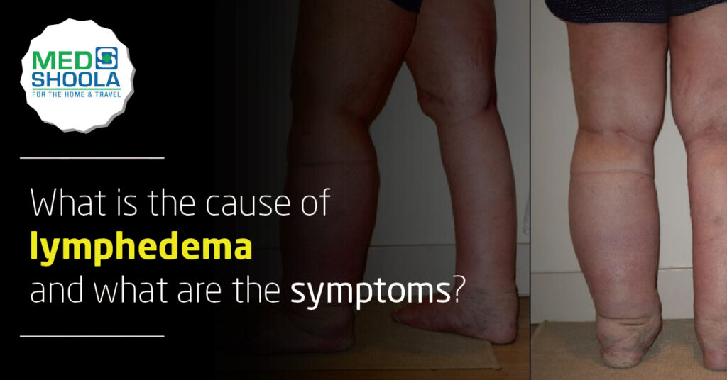 What Is The Cause Of Lymphedema And What Are The Symptoms